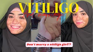 Vitiligo marriage  A problem  How vitiligo effects my marriage🙂 vitiligo education [upl. by Sibyl]