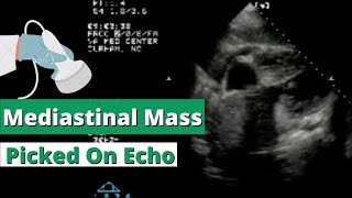 Echocardiography showing Mediastinal Mass in Subcostal View [upl. by Oniram8]