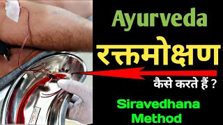 RAKTAMOKSHANA  Siravedhana Method  रक्तमोक्षण कैसे करते हैं [upl. by Eniloj]