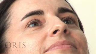 Botox training  Crows Feet  Oris Medical [upl. by Elem]