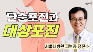 단순포진과 대상포진  서울대병원 피부과 정진호 [upl. by Rawden749]