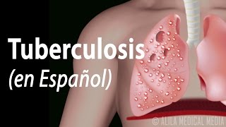 Tuberculosis Progresión de la Enfermedad Animación Alila Medical Media Español [upl. by Anma]