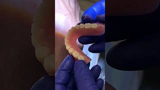 No More Moves your DenturesImplants OverDenturesshortsimplantsyoutubeshorts viral [upl. by Maise]