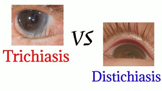 Difference between trichiasis and distichiasis  optometry club [upl. by Lind]