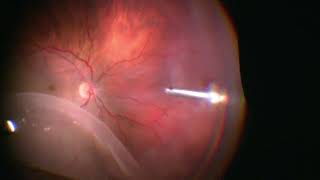 Vitrectomy for Giant Retinal Tear  Retinal Detachment  GRT  Dr Manish Nagpal [upl. by Erle]