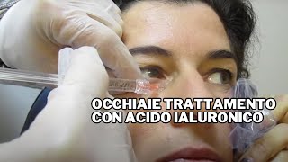 Occhiaie Trattamento con Acido Ialuronico [upl. by Nas]