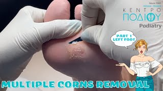 Corns Removal P1 feet κεντροποδιου foot podologos podiatrist corn footcare podiatry callus [upl. by Manvil]