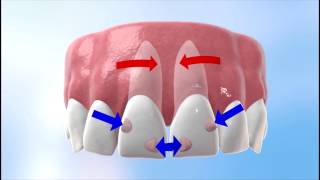 Discover how Invisalign works [upl. by Lenes]