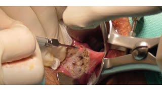 Cirugía Hemorroidal Laser  Hemorrhoid LASER procedure [upl. by Maisey]