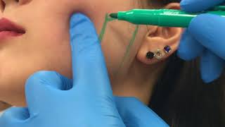 Treating enlarged masseter muscles with Botox by Dr Shaun Patel [upl. by Evadne941]