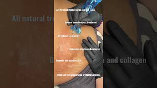 Benefits of Inkless Stretch Mark Treatment [upl. by Zeuqram]