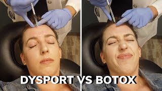 DYSPORT VS BOTOX 💉 CROWS FEET FOREHEAD 11s BEFORE amp AFTER DOES IT WORK PAIN [upl. by Worthy]