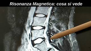 Risonanza Magnetica cosa si vede [upl. by Ecnirp]