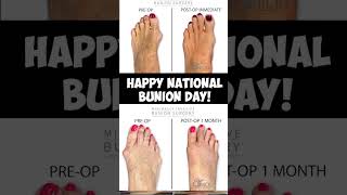 Minimally Invasive Bunion Surgery  Dr Nick [upl. by Pretrice]