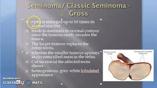 Pathology 711 cd Seminoma testis Gross Tumor cancer [upl. by Bhatt900]