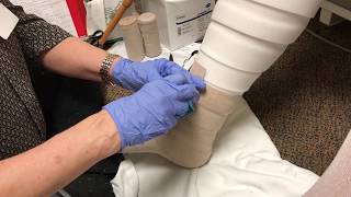 Lymphedema Therapy and Compression Wrapping Bandaging for Legs [upl. by Ydnar]