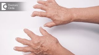 Signs and symptoms of Rheumatoid Arthritis  Dr Prashanth Jain [upl. by Ahnavas914]