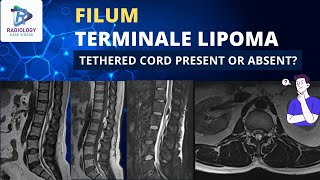 Filum Terminale Lipoma  Tethered Cord Present or Absent  Dr Umamaheswara Reddy V [upl. by Hamrnand]