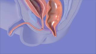 Anorectal Malformation Surgery [upl. by Jemimah]