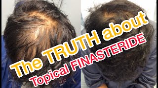 Topical Finasteride  Minoxidil results after 6 Months [upl. by Aeret]