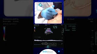 EcoimagenTips  Doppler para evaluar el cordón umbilical Parte 2 👩🏻‍🍼 [upl. by Portugal915]