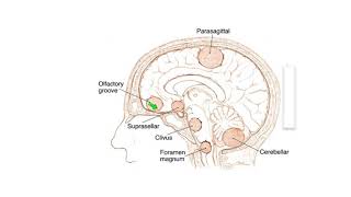 Meningiomas Signs Symptoms and Advanced Treatment Options [upl. by Ube]