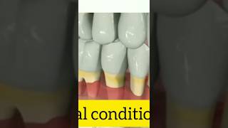 Masude kyun apni jagah chodte hain l Gum recession gumdisease teeth [upl. by Nythsa]