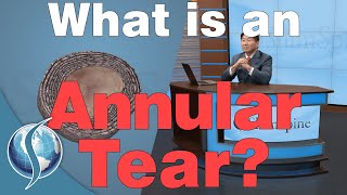 What Is An Annular Tear [upl. by Cas367]