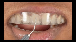 Direct composite veneers  Injection moulding technique  Complete Digital Workflow [upl. by Ahsea]