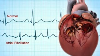 MM  Medical Cardioversion of Atrial Fibrillation in the ER [upl. by Olegnad]