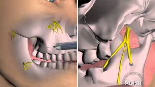 мандибулярная анестезия по вазирани акинозиmandibular anesthesia for Vazirani akinozi [upl. by Nosylla]