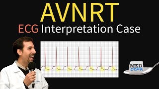 AV Nodal Reentry Tachycardia AVNRT on ECG  EKG [upl. by Penthea]