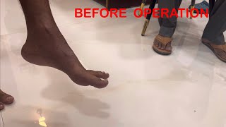 Before Operation and 2 Months after Operation Foot deformity Foot drop [upl. by Yatnuahs278]