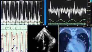 Constrictive pericarditis diagnosis echocardiography and treatment [upl. by Yorel162]