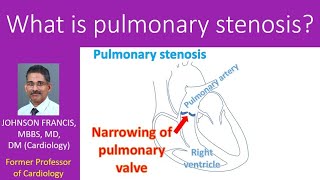 What is pulmonary stenosis [upl. by Nancy]