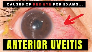 Causes of Red Eye  Part 2 ANTERIOR UVEITIS Iritis [upl. by Anaujd815]