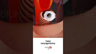 Laryngectomy Throat Cancer Surgery ↪ 3D Medical Animation Shorts Laryngectomy Throat Surgery [upl. by Daiz]