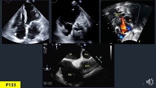 Anatomy Of Heart In Echo Part 6 Right Atrium [upl. by Roddie]