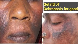 How To Treat Ochronosis  Causes Of Ochronosis and Prevention [upl. by Yadnil96]