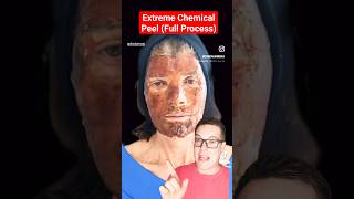 ALARMING CHEMICAL PEEL  Full Phenol Peel Process shorts [upl. by Amati]