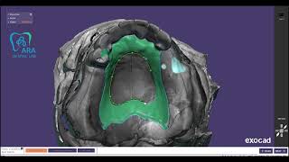 upper partial frame design with EXOCAD AP bar [upl. by Nerwal]