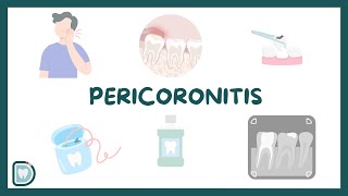 Relief from Wisdom Tooth Pain Understanding Pericoronitis [upl. by Lally]