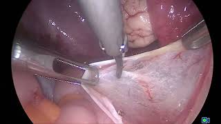 Lap excision of incidentally found deep endometriosis in a patient with mucinous ovarian cyst [upl. by Palestine218]