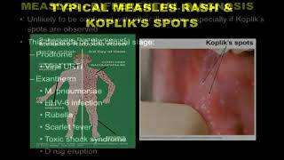 Measles Overview of epidemiology pathogenesis presentation and diagnosis [upl. by Ynnel]