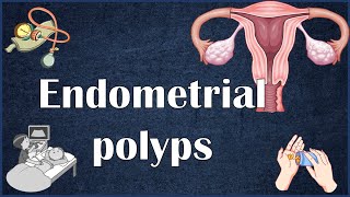 Endometrial Uterine Polyps  Everything You Need To Know [upl. by Darooge]