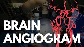 Angiogram  BRAIN angio procedure video [upl. by Torbart]