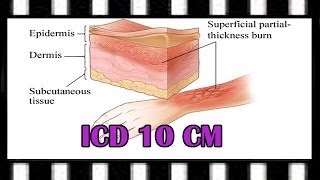 ICD10 Training — ICD10CM Burns and TBSA [upl. by Thalia]