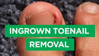 Ep 59 Ingrown Toenail Removal Procedure  The Scope [upl. by Imiaj]