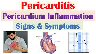 Pericarditis Pericardial Inflammation Signs amp Symptoms amp Why They Occur [upl. by Eleonore]