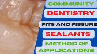 Method of Sealent ApplicationPits and fissure sealants procedurePits and fissure sealants in Hindi [upl. by Leraj711]